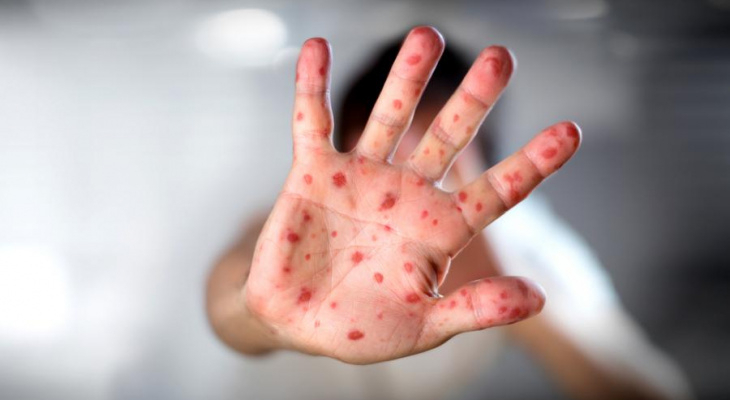 Эпидемия кори: владимирцам рекомендуют сделать прививку