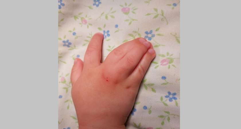 Во Владимире врачи помогли малышу со сросшимися пальцами на руках