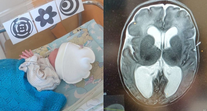 Врачи ОДКБ обнаружили у новорожденного редкое заболевание 