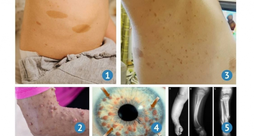 Врачи Владимирской ОДКБ помогают ребенку с нейрофиброматозом