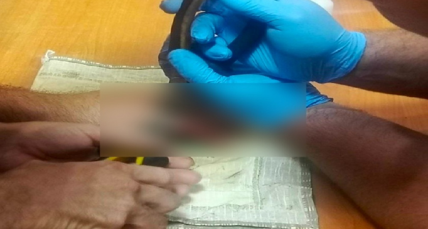 Молодой спортсмен из Владимира едва не лишился пальца на тренировке