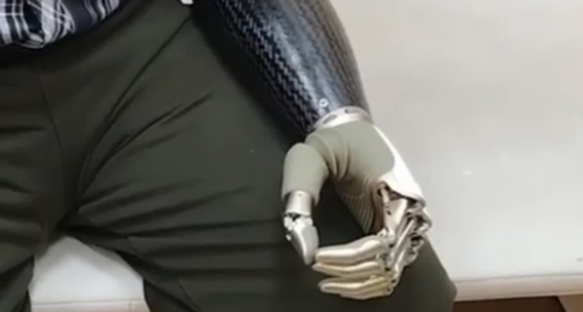 Житель Владимирской области получил бионическую кисть за 3,3 млн рублей