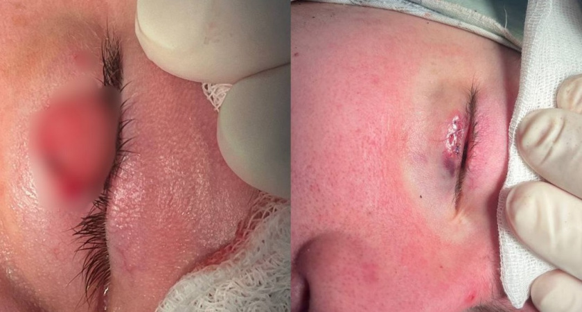 Владимирские врачи избавили подростка от ячменя размером с орех