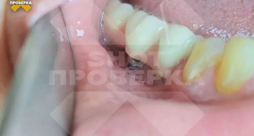 Жительница Владимира отсудила несколько миллионов рублей за ошибку стоматолога