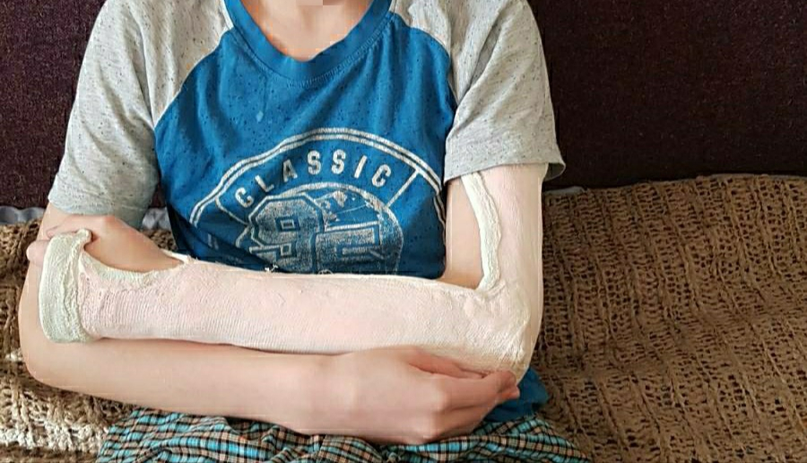 Мальчик сломал руку на физкультуре при выполнении запрещенного для него упражнения