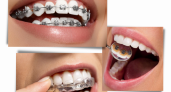 Ортодонтия – это здоровые зубы, эстетика лица и красивая улыбка в любом возрасте