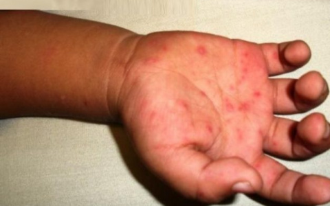 Во Владимире у воспитанника детсада педиатр заподозрила Коксаки