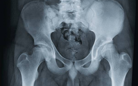 Во Владимире врачи извлекли из мужчины ножку стула