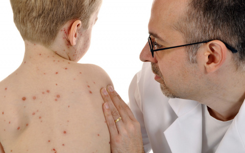 Во Владимире зафиксирована вспышка кори