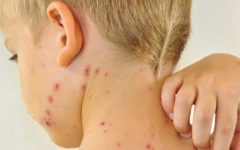 Вирус кори во Владимире продолжает "зверствовать"