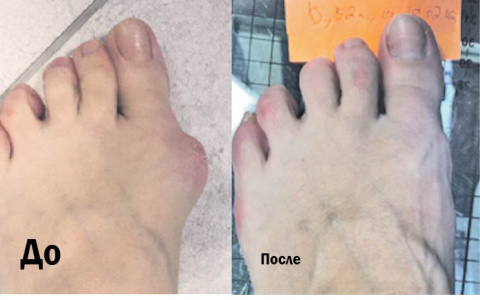 Владимирцы смогут бесплатно удалить шишку на ноге