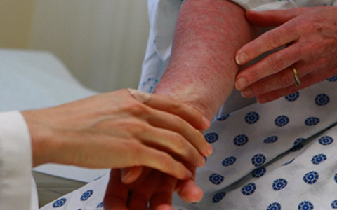 Владимирские врачи  теперь могут лечить тяжелые формы псориаза