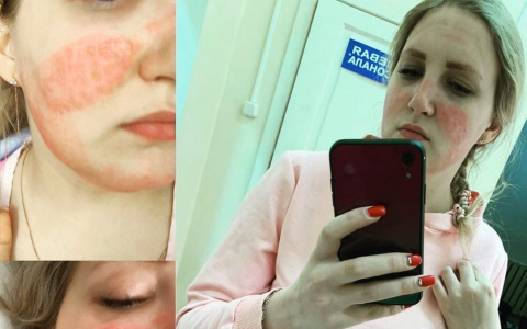 Медсестра из Александрова получила ожоги из-за костюма химзащиты