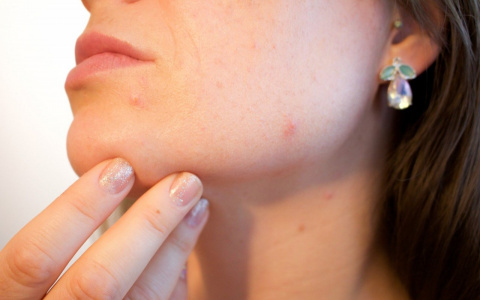 Прыщавая кровь: у людей с этой группой крови часто высыпают прыщи на лице