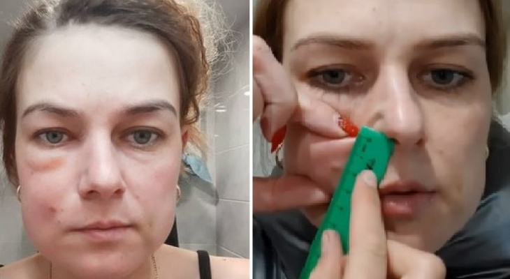 После уколов красоты женщина из Владимира попала в больницу После уколов красоты женщина из Владимира попала в больницу