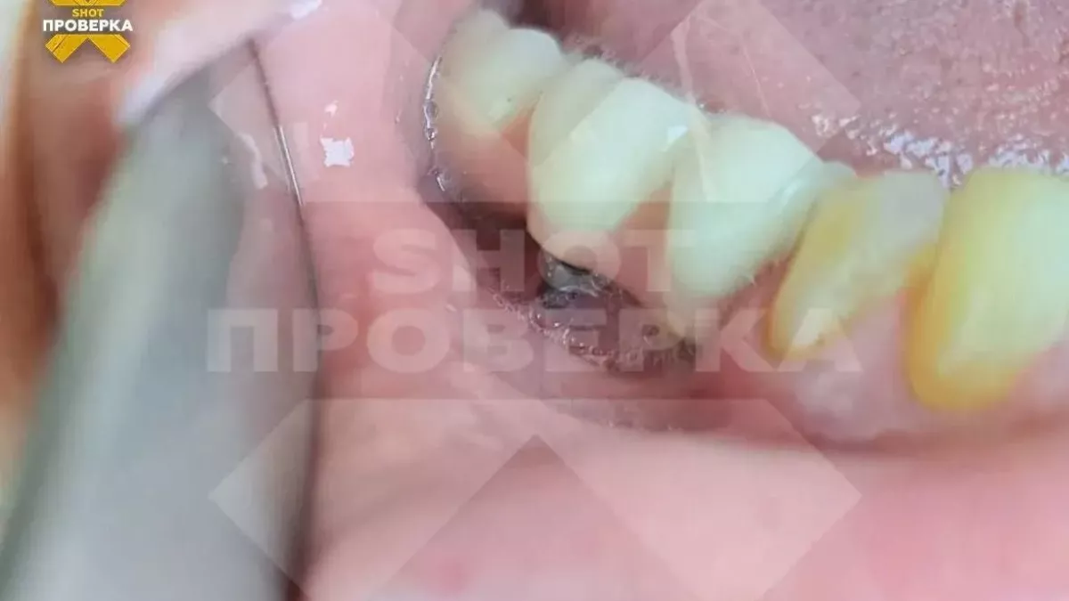 Жительница Владимира отсудила несколько миллионов рублей за ошибку стоматолога