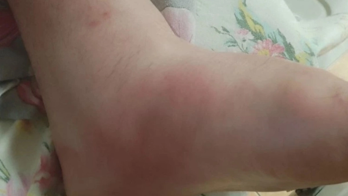 Двое жителей Владимира попали в реанимацию после укусов гадюк этим летом