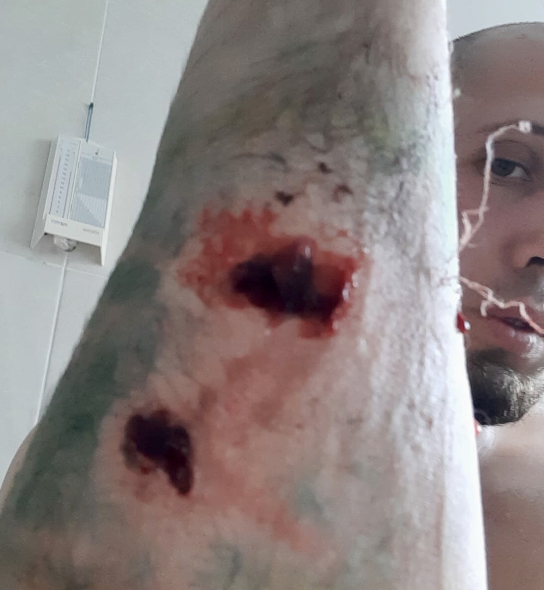 В Муроме альпинист получил рваные раны от собаки