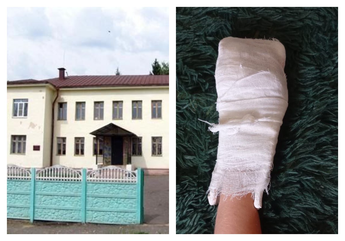 Во Владимирской области по недосмотру педагога у ребёнка-инвалида теперь искалечена рука